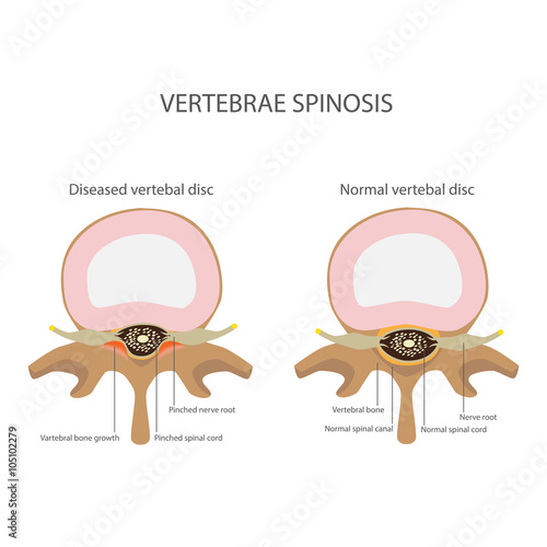 back pain. spin stenosis. vertebrae disease vector format