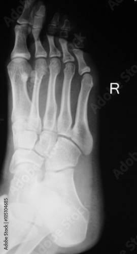 Foot and toes injury xray scan