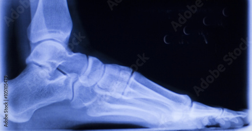 Foot and toes injury xray scan