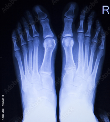 Foot and toes injury xray scan