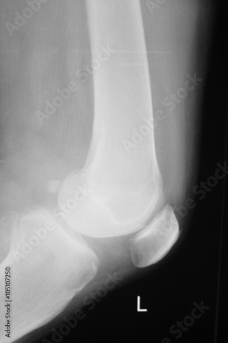 Knee and meniscus injury xray scan