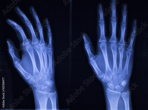 Hand fingers thumb wrist xray scan