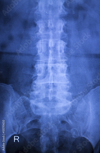 Spine vertebra back injury xray scan