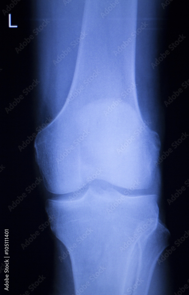 Knee and meniscus injury xray scan Knee and meniscus injury xray scan