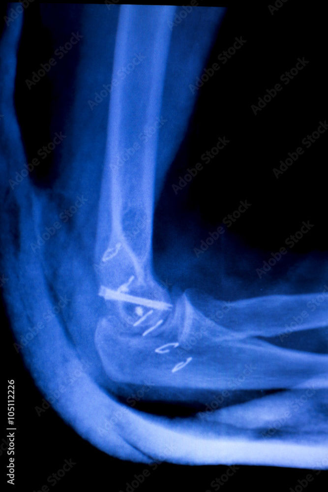 Elbow arm orthopedic implant xray scan Elbow arm orthopedic implant xray scan