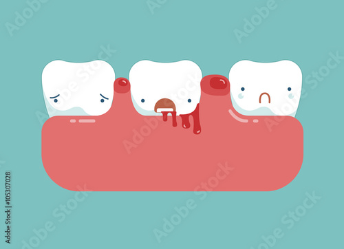 Gingivitis and blood ,dental concept