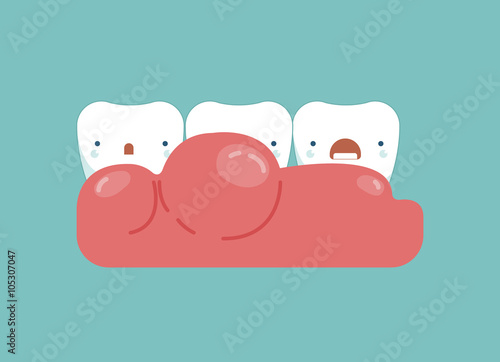  Gingivitis around the teeth ,dental concept