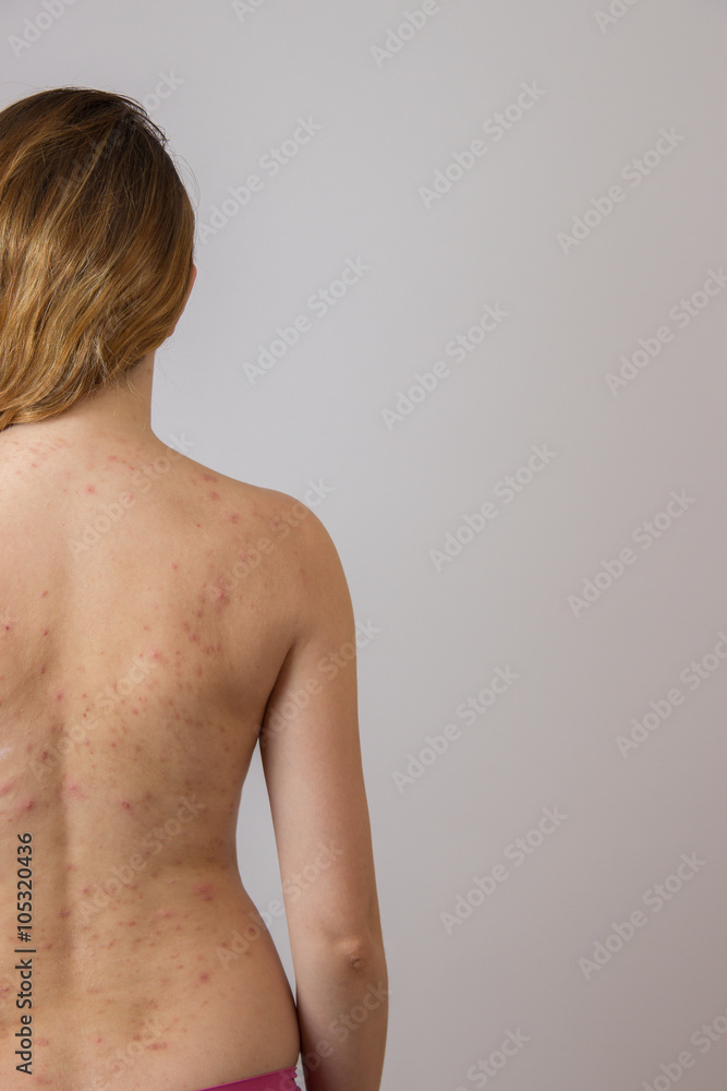 Young girl with acne, with red  spots on the back