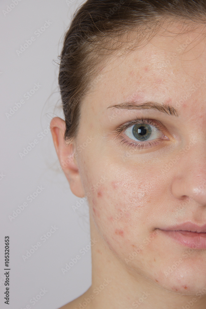 Fototapeta premium Beautiful young girl with acne on his face and the back on a whi