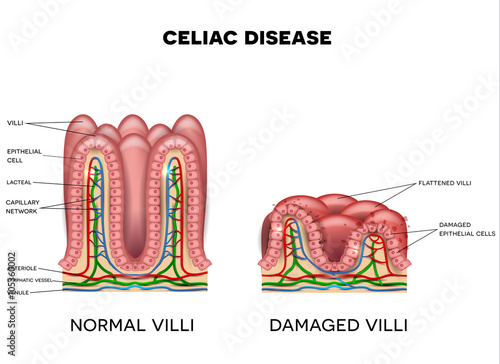 Celiac disease affected small intestine villi on a white background. Healthy villi and unhealthy villi with damaged cells photo