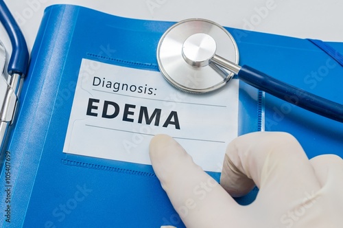 Edema - lymphatic diagnosis on blue folder with stethoscope. photo