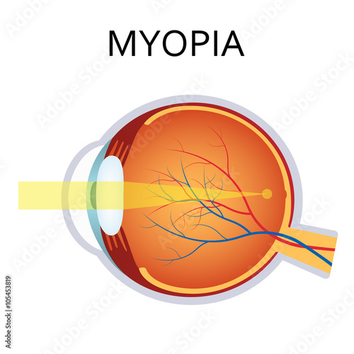 Myopia. Myopia is being short sighted.