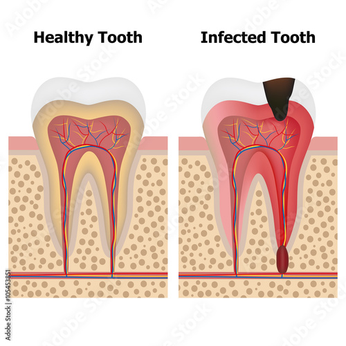 Pulpitis and Healthy tooth