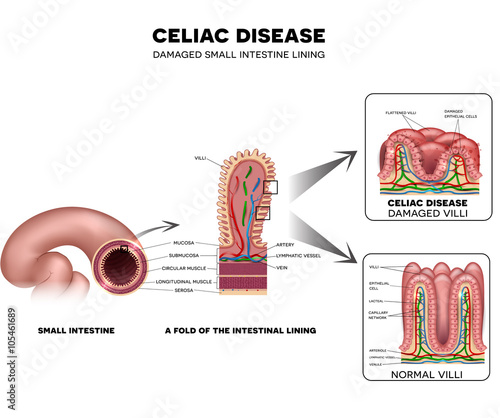 Celiac disease Small intestine lining damage. Healthy villi and damaged villi. Small intestine, a fold of the intestinal lining and villi.