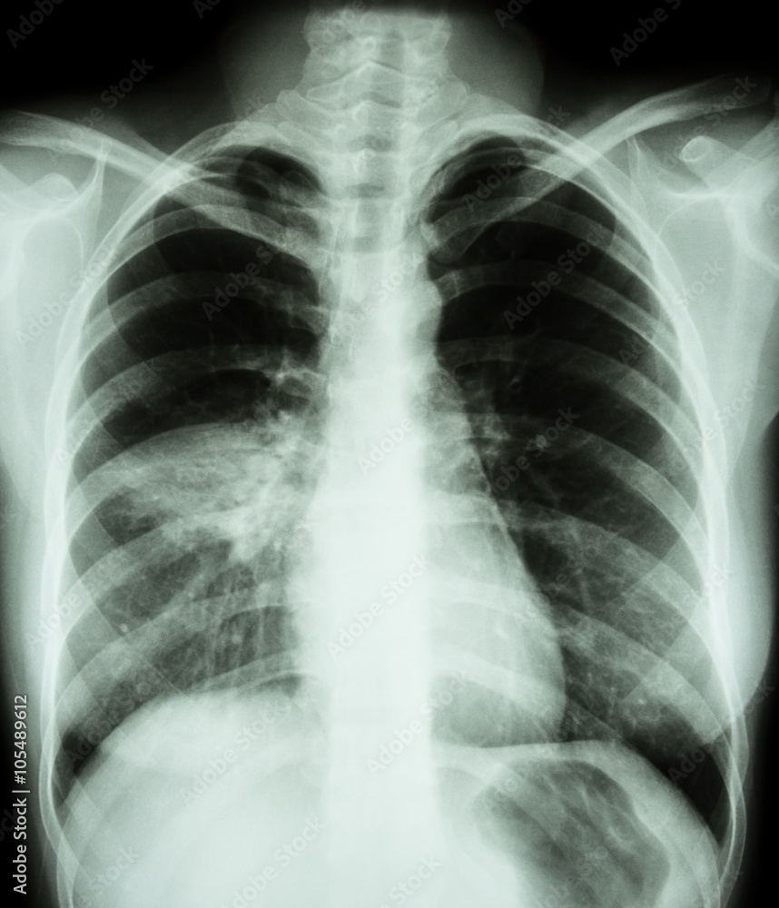 Pneumonia ( film chest x-ray show alveolar infiltrate at right middle lung ) ( image for pulmonary tuberculosis , Mers-CoV , SARS ) Pneumonia ( film chest x-ray show alveolar infiltrate at right middle lung ) ( image for pulmonary tuberculosis , Mers-CoV , SARS )