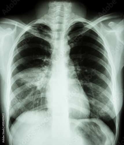 Pneumonia ( film chest x-ray show alveolar infiltrate at right middle lung ) ( image for pulmonary tuberculosis , Mers-CoV , SARS )