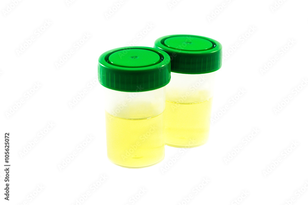 Urine specimen for urinalysis on white background Urine specimen for urinalysis on white background