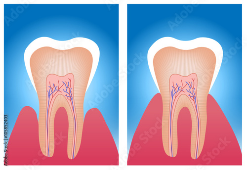 hypersensitive teeth and normal teeth