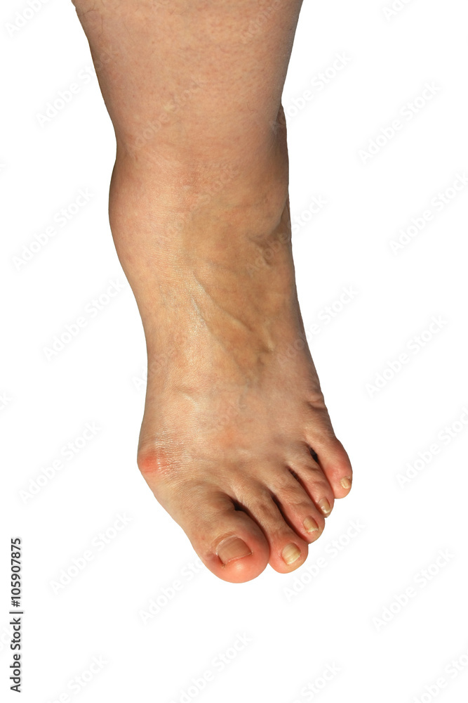 deforming arthrosis on leg deforming arthrosis on leg