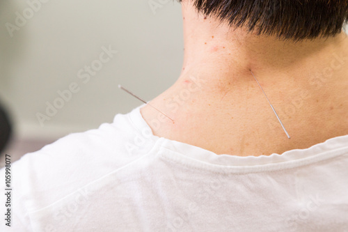 Focus on acupuncturist needle pricking into skin, with shallow depth of field