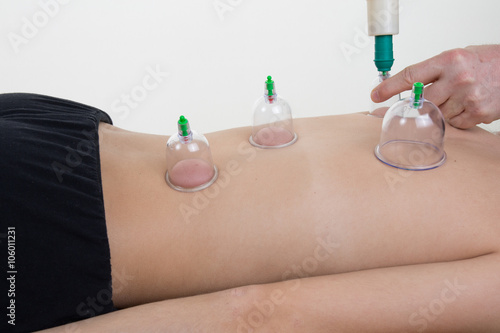 Caucasian female laying and get a cupping therapy