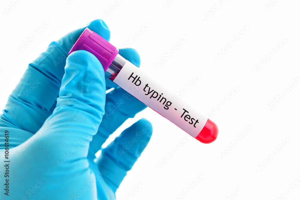 Obraz premium Blood sample for hemoglobin (Hb) typing test, thalassemia diagnosis 