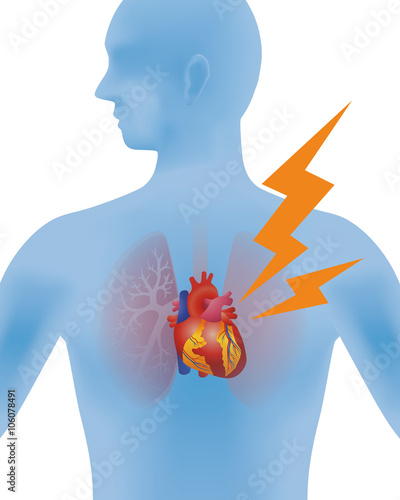 the heart of human, heart infarction, vector illustration