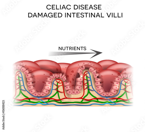 Celiac disease affected small intestine villi. Damaged cells by body's reaction to gluten. Intestinal villi do not absorb nutrients because of reduced surface area.