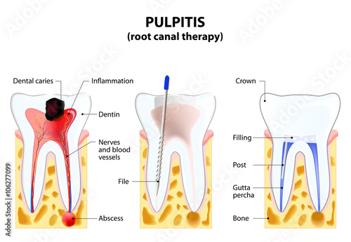 Pulpitis. root canal therapy photo