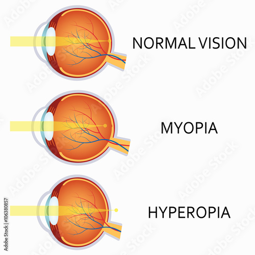 Optical human eye defects. Myopia and hyperopia. photo