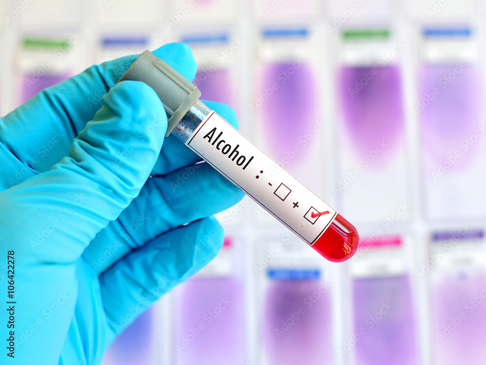 Blood sample positive with alcohol testing Blood sample positive with alcohol testing