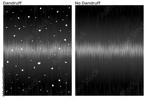 dandruff hair and good hair , before and after