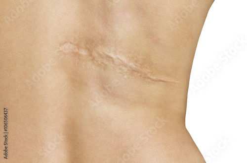 Photo Scar after operation on back of women on white background