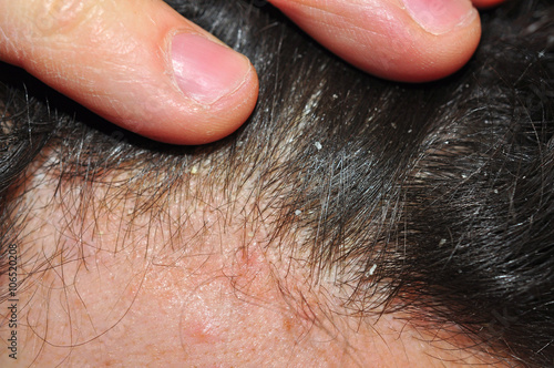 Photos Itchy hair skin, dandruff psoriasis trouble
