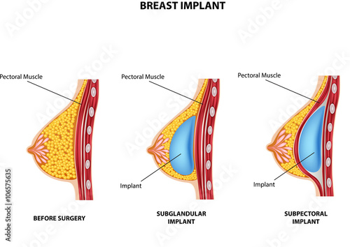Illustration of Plastic surgery of breast implant
