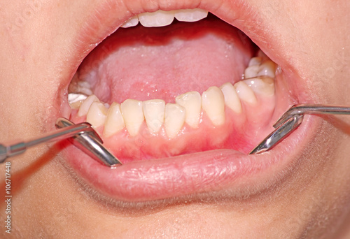 Malocclusion. Crowding of the teeth