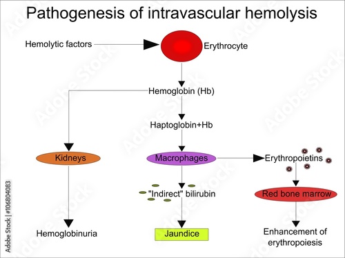 Pathogenesis of intravascular hemolysis 