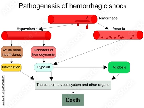 Schematic pathogenesis of hemorrhagic shock 