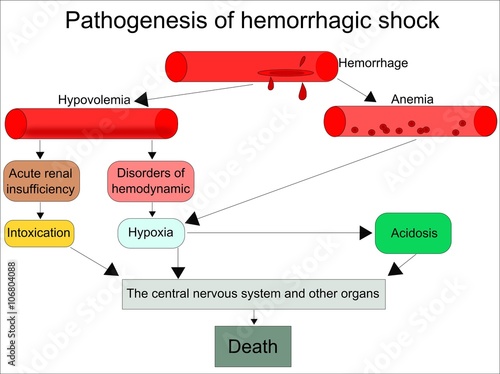 Schematic pathogenesis of hemorrhagic shock  photo