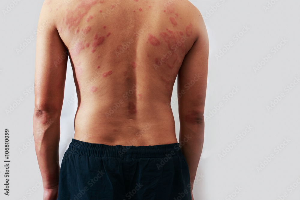 Around Back view of man with dermatitis problem of rash ,Allergy  