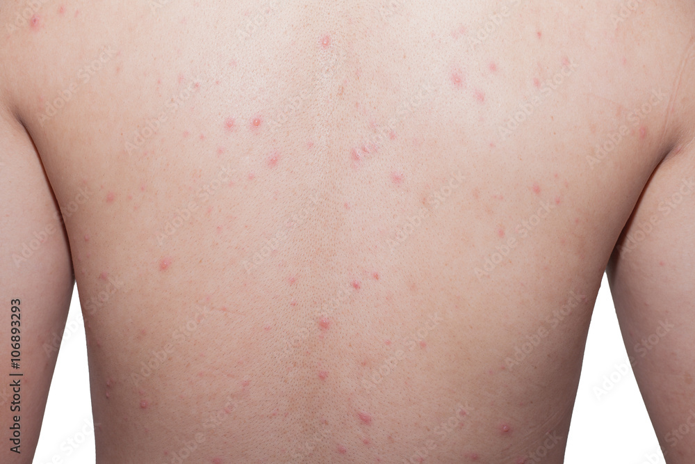4 days after infection with chickenpox back view. 4 days after infection with chickenpox back view.