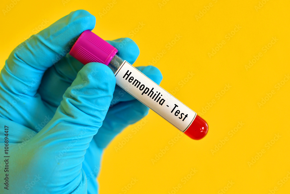 Fototapeta premium Hemophilia test