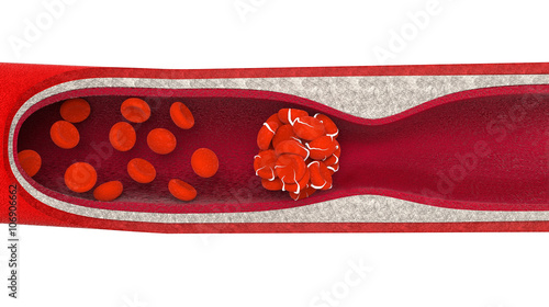Tablou pe pânză A blood clot, blood clot, blood poisoning or cancer, on a white background