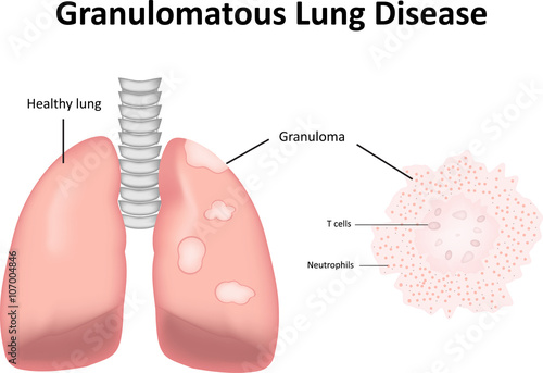 Granulomatous Lung Disease Labeled