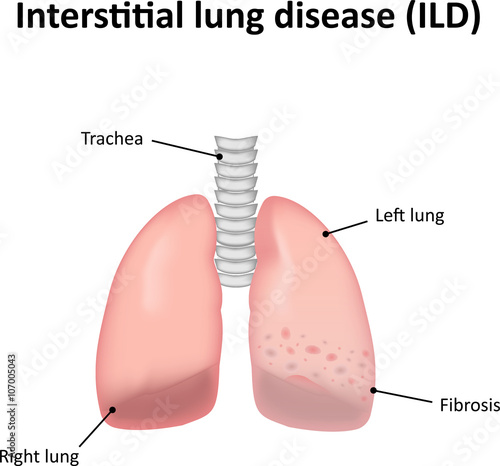 Interstitial Lung Disease 