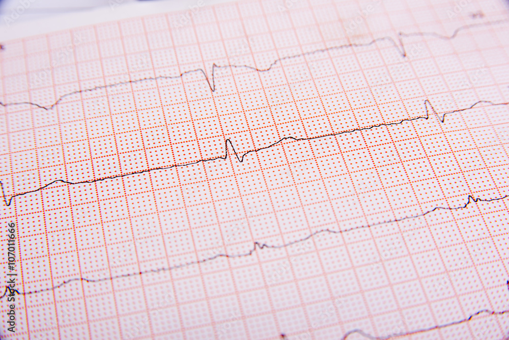 Electrocardiogram close-up Electrocardiogram close-up