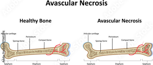 Avascular Necrosis photo