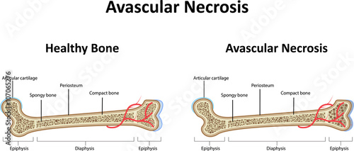 Avascular Necrosis
