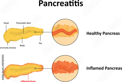 Pancreatitis photo