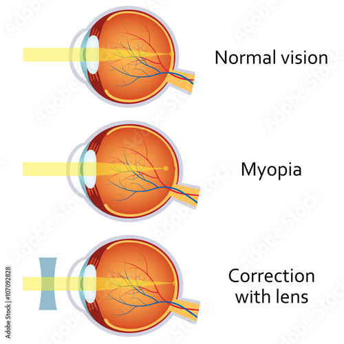 Myopia and myopia corrected by a minus lens. photo